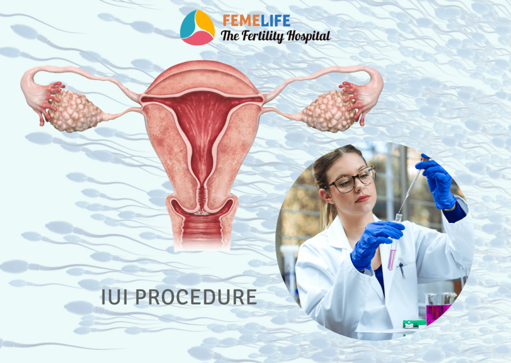 IUI Procedure 